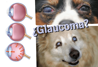 El glaucoma
